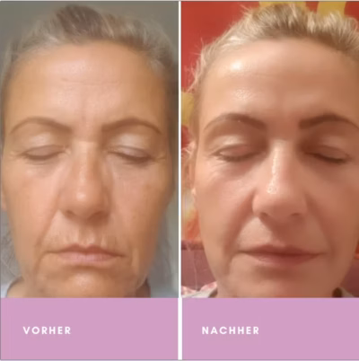 Vergesse Botox! Diese Wirkstoffe straffen Deine Haut natürlich